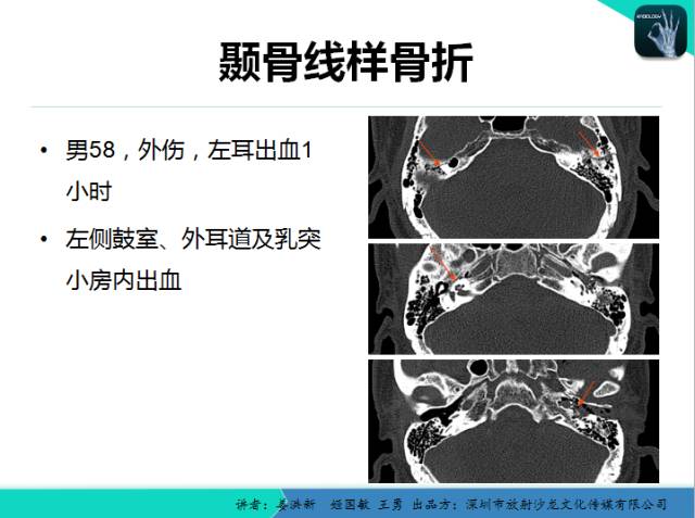 【PPT】耳部疾病CT及MRI诊断