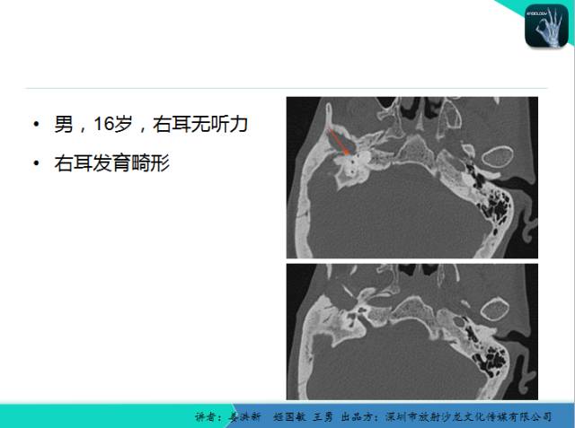 【PPT】耳部疾病CT及MRI诊断
