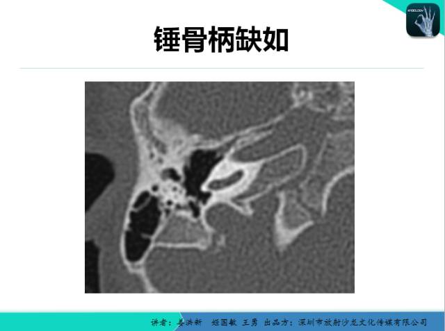 【PPT】耳部疾病CT及MRI诊断