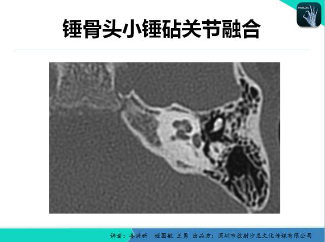 【PPT】耳部疾病CT及MRI诊断