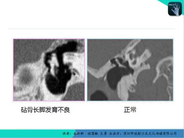 【PPT】耳部疾病CT及MRI诊断