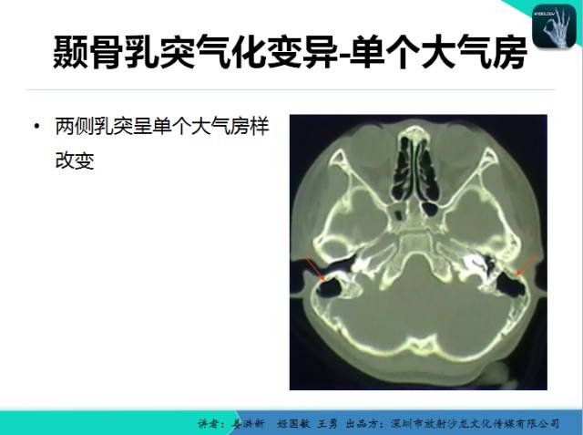 【PPT】耳部疾病CT及MRI诊断