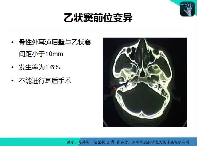 【PPT】耳部疾病CT及MRI诊断