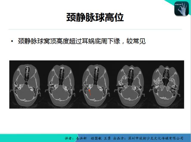 【PPT】耳部疾病CT及MRI诊断