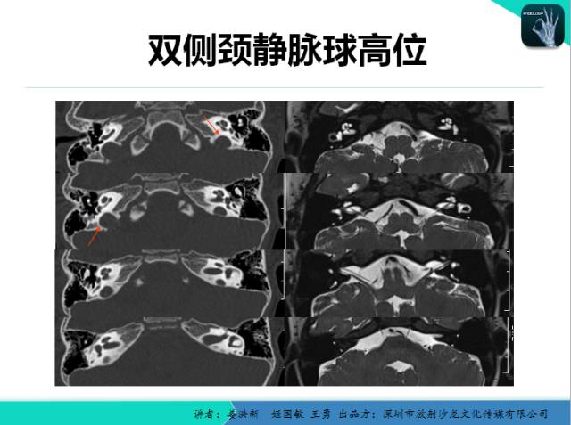 【PPT】耳部疾病CT及MRI诊断
