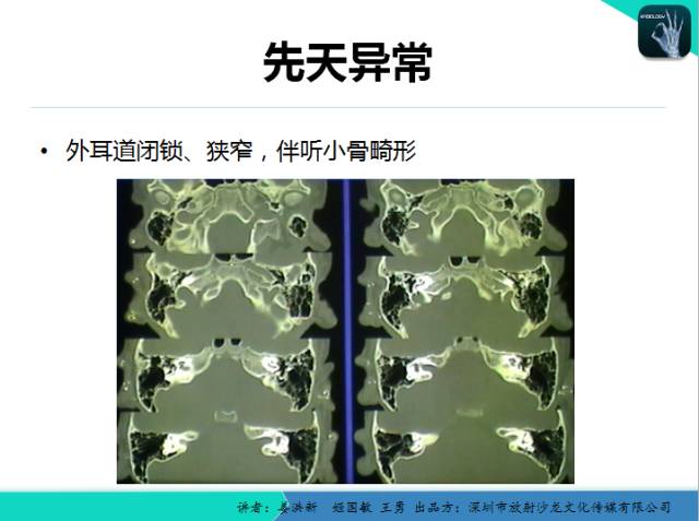 【PPT】耳部疾病CT及MRI诊断