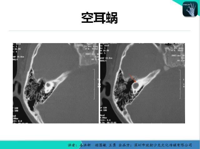 【PPT】耳部疾病CT及MRI诊断