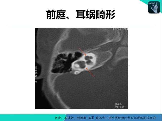 【PPT】耳部疾病CT及MRI诊断