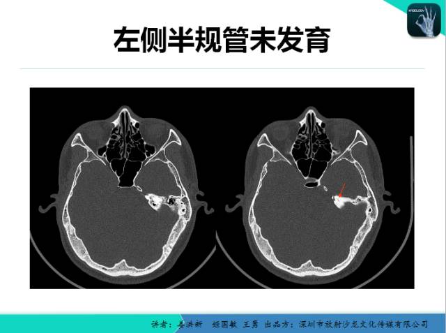 【PPT】耳部疾病CT及MRI诊断