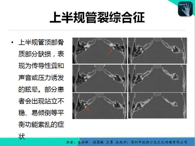 【PPT】耳部疾病CT及MRI诊断