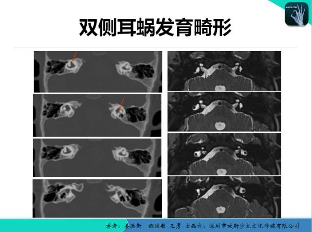 【PPT】耳部疾病CT及MRI诊断