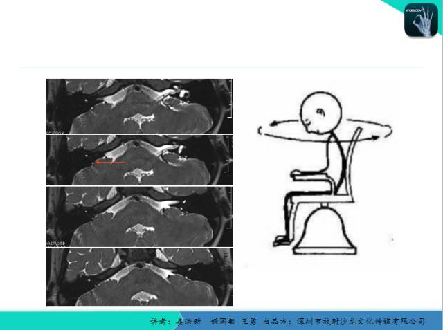 【PPT】耳部疾病CT及MRI诊断
