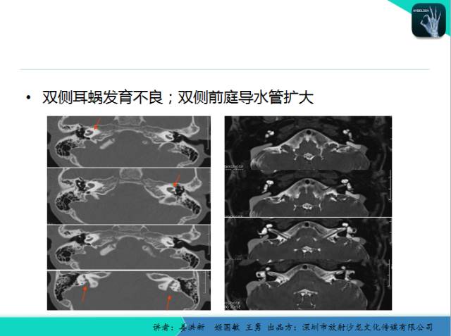 【PPT】耳部疾病CT及MRI诊断