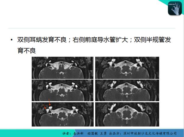 【PPT】耳部疾病CT及MRI诊断