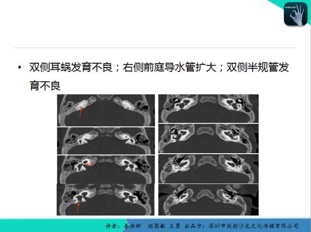 【PPT】耳部疾病CT及MRI诊断