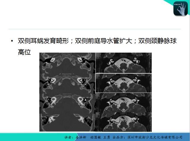 【PPT】耳部疾病CT及MRI诊断