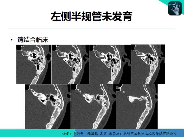 【PPT】耳部疾病CT及MRI诊断