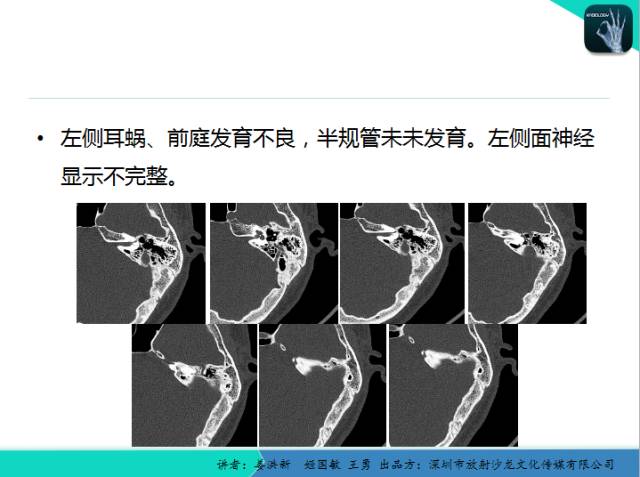【PPT】耳部疾病CT及MRI诊断