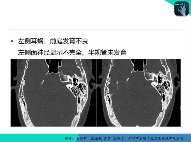 【PPT】耳部疾病CT及MRI诊断
