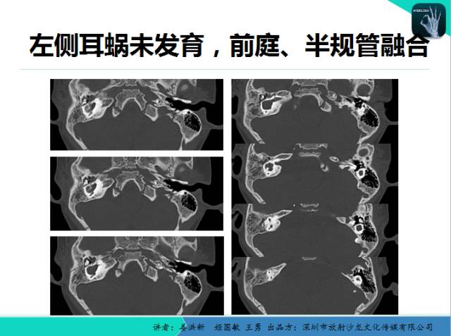 【PPT】耳部疾病CT及MRI诊断