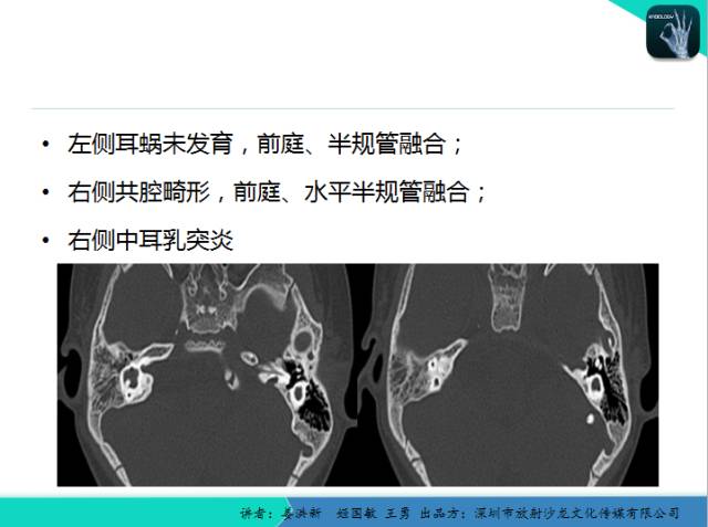 【PPT】耳部疾病CT及MRI诊断