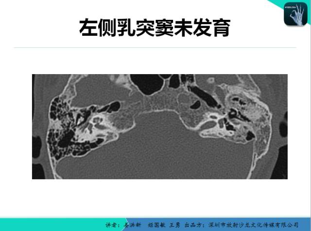 【PPT】耳部疾病CT及MRI诊断