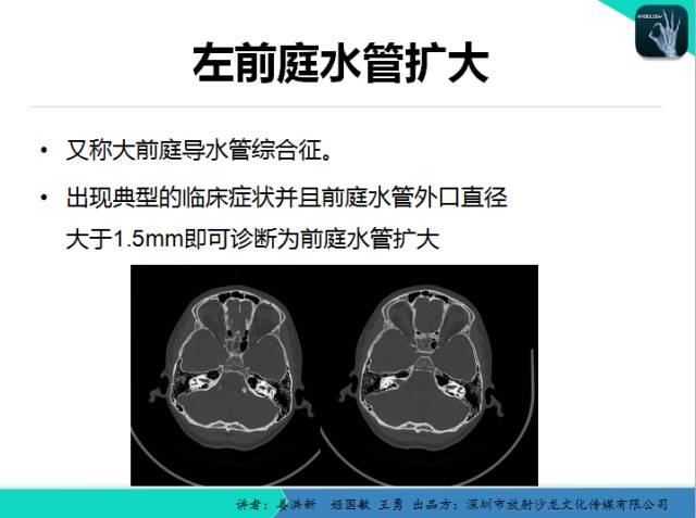 【PPT】耳部疾病CT及MRI诊断