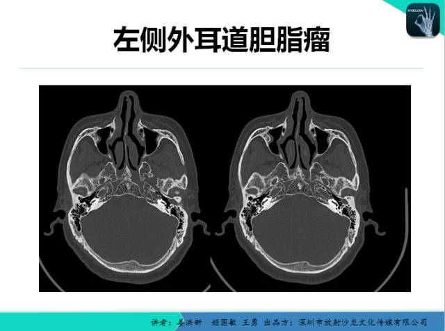 【PPT】耳部疾病CT及MRI诊断