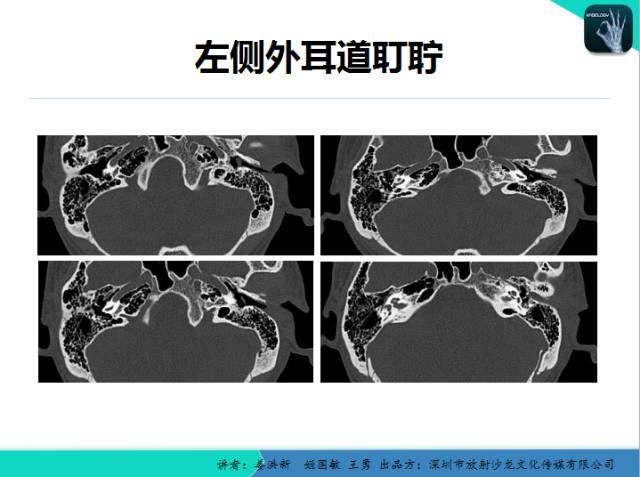【PPT】耳部疾病CT及MRI诊断