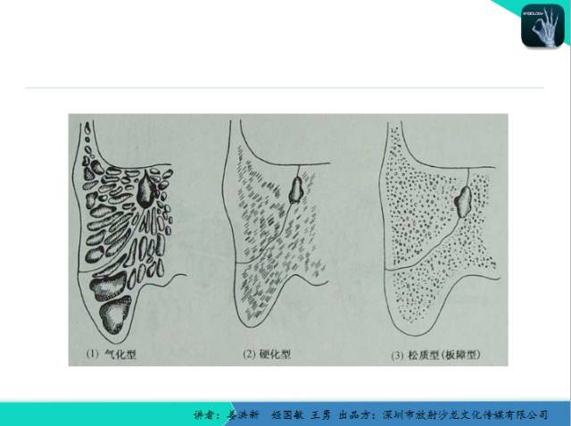 【PPT】耳部疾病CT及MRI诊断