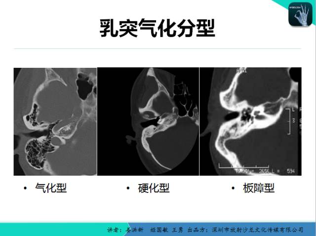 【PPT】耳部疾病CT及MRI诊断