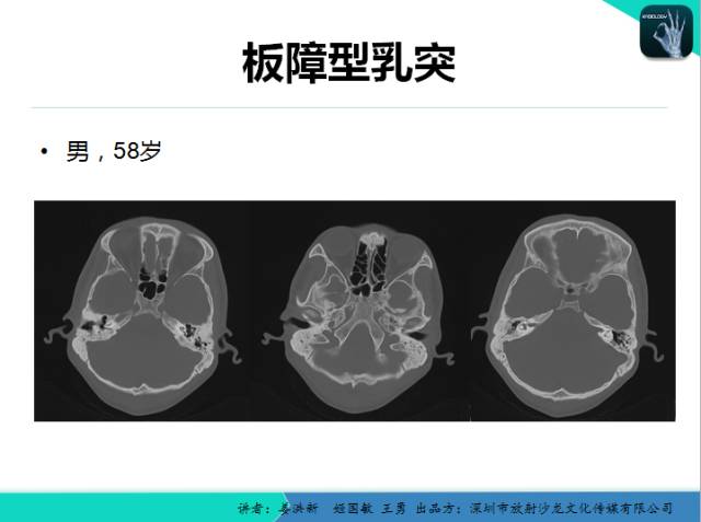 【PPT】耳部疾病CT及MRI诊断