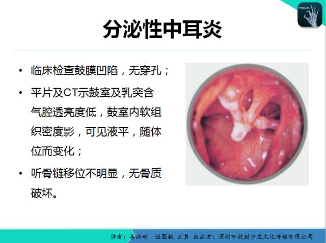 【PPT】耳部疾病CT及MRI诊断