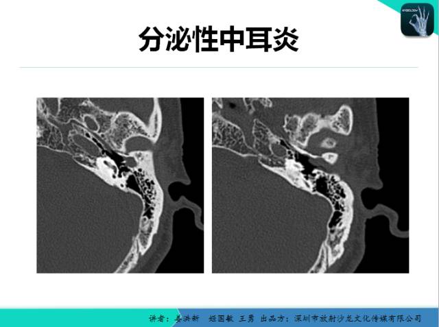 【PPT】耳部疾病CT及MRI诊断