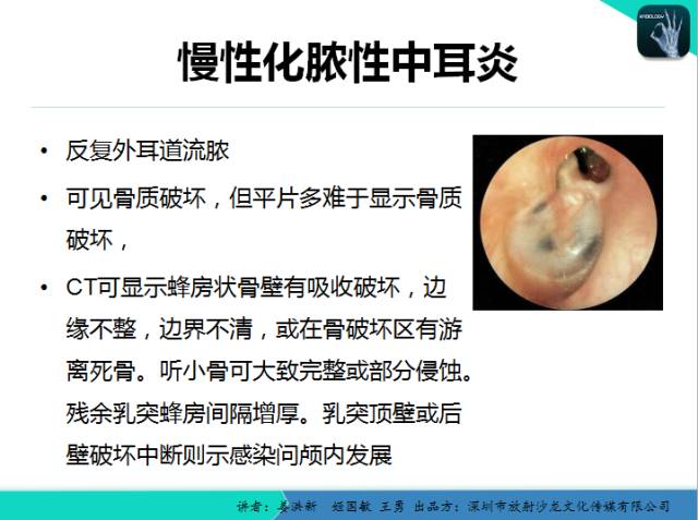 【PPT】耳部疾病CT及MRI诊断