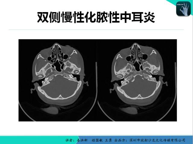 【PPT】耳部疾病CT及MRI诊断