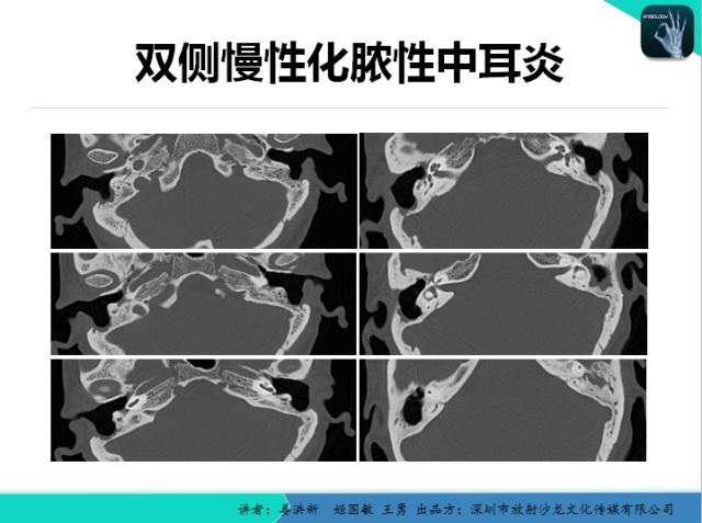 【PPT】耳部疾病CT及MRI诊断