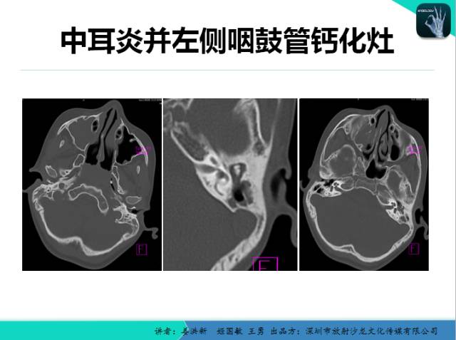 【PPT】耳部疾病CT及MRI诊断