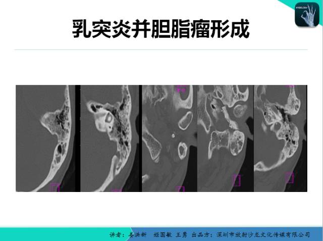 【PPT】耳部疾病CT及MRI诊断