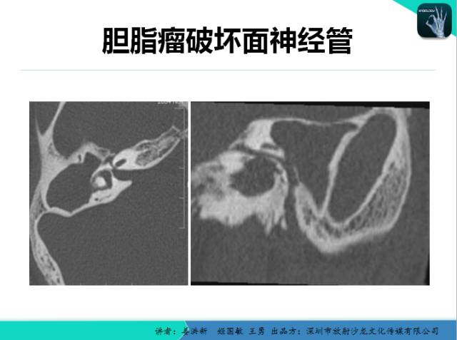 【PPT】耳部疾病CT及MRI诊断