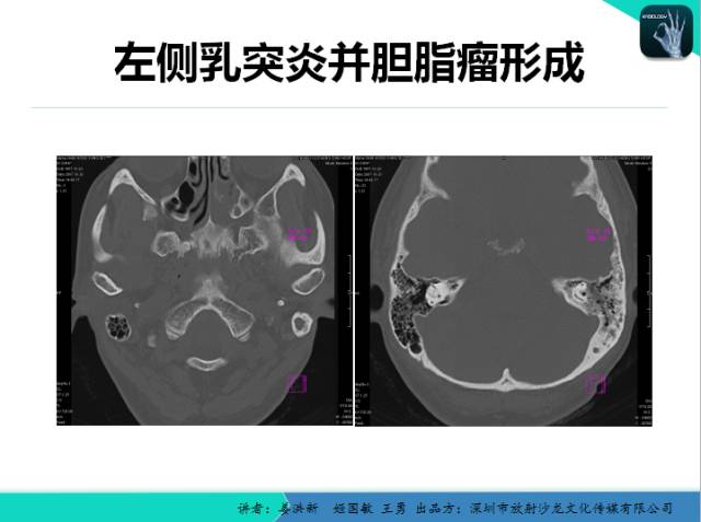 【PPT】耳部疾病CT及MRI诊断