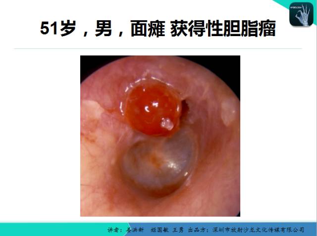 【PPT】耳部疾病CT及MRI诊断