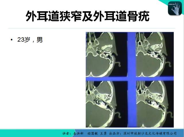 【PPT】耳部疾病CT及MRI诊断
