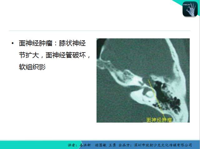 【PPT】耳部疾病CT及MRI诊断