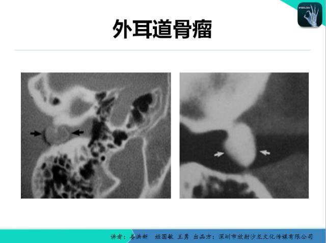 【PPT】耳部疾病CT及MRI诊断