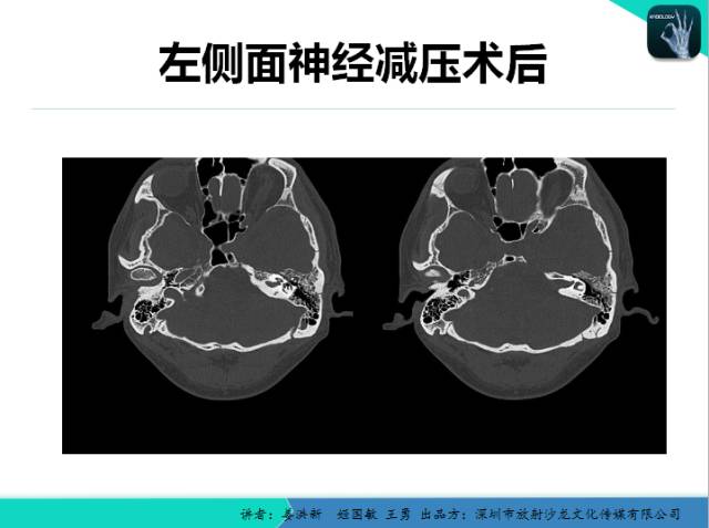 【PPT】耳部疾病CT及MRI诊断