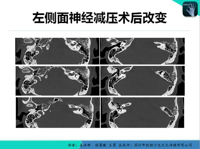 【PPT】耳部疾病CT及MRI诊断