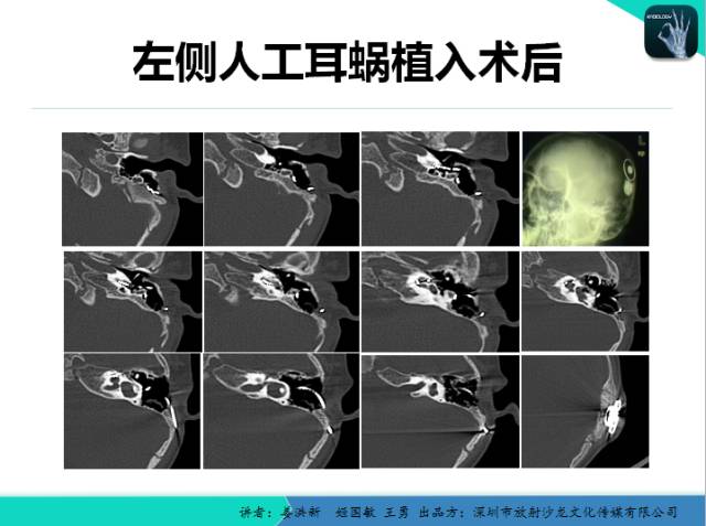 【PPT】耳部疾病CT及MRI诊断
