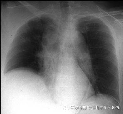 【病例】纵隔积气1例X线影像表现
