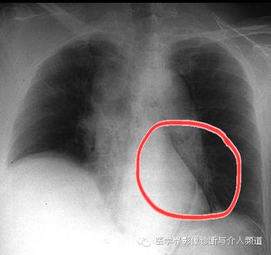 【病例】纵隔积气1例X线影像表现 【病例】纵隔积气1例X线影像表现